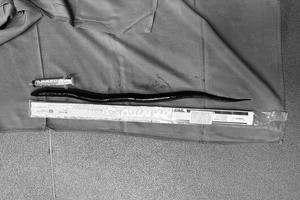 Hi hữu: Thủng ruột do có con lươn dài 30 cm trong bụng