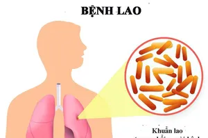Mỗi năm khoảng 13.000 người tử vong do bệnh lao, nhiều người giấu bệnh, mặc cảm