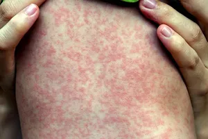 Hà Nội: Ca mắc rubella đầu tiên trong năm 2024 đã tiêm vaccine phòng bệnh