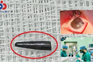 Bé trai 9 tháng tuổi bị ruột bút chì đâm thủng nhãn cầu