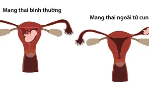 Có thai nhưng không đi khám, người phụ nữ suýt tử vong vì thai ngoài tử cung