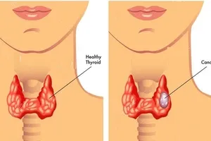 Bị ung thư di căn ở tuổi 24