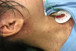 Cô gái suýt tử vong do mắc thủy đậu