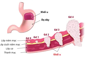 Bác sĩ khuyến cáo việc bệnh nhân uống thuốc nam làm tan khối u