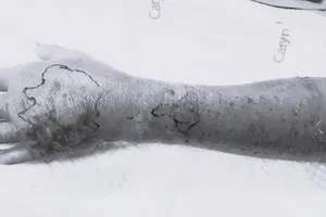 Bị trẻ 3 tuổi cắn, người đàn ông sốt cao nhập viện