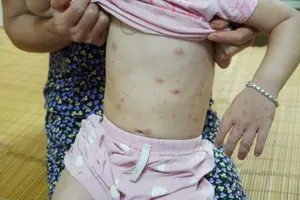 Bé gái 3 tuổi bị nhiễm trùng nặng do mắc thủy đậu