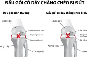 Sau 20 năm bị ngã mới biết mình bị đứt dây chằng khớp gối