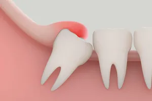 Lưu ý khi nhổ răng khôn mọc lệch