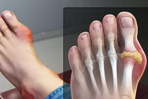 Người bệnh gút nên ăn gì ngày Tết?