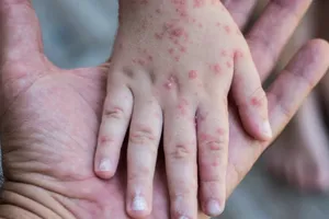 Bé gái 4 tuổi tử vong do sởi sau 1 ngày nhập viện