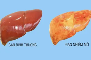Những cách giúp ngăn ngừa gan nhiễm mỡ