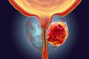 Ung thư tuyến tiền liệt di căn xương nguy hiểm thế nào?