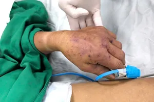 Hà Nội ghi nhận ca đầu tiên tử vong do liên cầu lợn