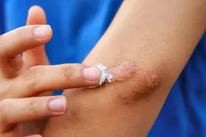 Đình chỉ, thu hồi toàn quốc 1 loại gel ngừa sẹo do vi phạm 3 lỗi