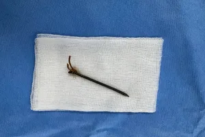 Người đàn ông bất ngờ bị đinh sắt cắm sâu vào giữa cổ