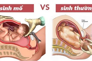 Mất con vì chọn ngày giờ đẹp để sinh mổ