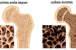 Ăn gì để đề phòng thiếu canxi?