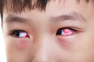 HCDC cảnh báo nguy cơ gia tăng bệnh truyền nhiễm mùa tựu trường