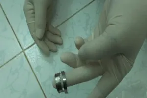 Lỡ nghịch dại đeo nhẫn, 'của quý' suýt hoại tử