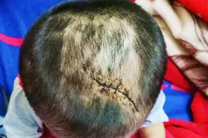 Bé 3 tuổi nghi bị cha dượng bạo hành 