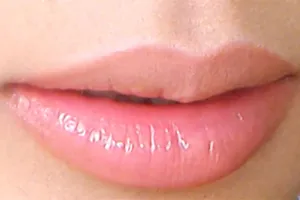 Đâm người ở cơ sở thẩm mỹ vì sửa môi không như ý