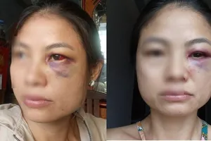 Người phụ nữ ở Đồng Nai cầu cứu vì liên tục bị chồng bạo hành