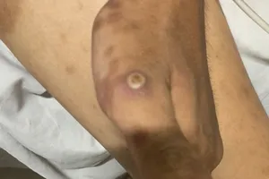 Phát hiện thêm 1 ca mắc bệnh đậu mùa khỉ ở Đồng Nai