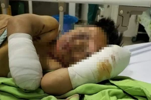 Bé trai 8 tuổi bị mất hai bàn tay nghi do nổ pháo