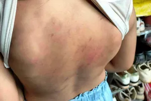 Học sinh lớp 4 bị đánh bầm tím nhà trường muốn dùng "đức trị" để răn đe