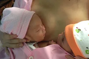 Cứu sống anh em sinh non bị suy hô hấp nặng