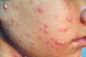 Phân biệt bệnh sởi và thủy đậu