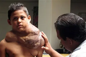 Loại bỏ khối u khổng lồ trên vai cậu bé 11 tuổi