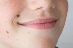 Nốt ruồi như thế nào thì nên đi khám?