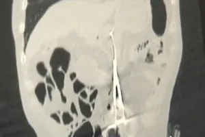 Bỏ quên kéo 20cm trong bụng bệnh nhân 12 năm