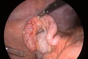 Tử vong vì bị cắt túi mật khi mổ ruột thừa