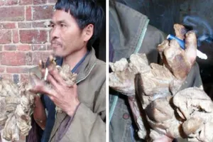 Bệnh lạ: Chân tay tự nhiên biến thành... củi khô