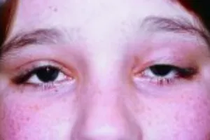 Dấu hiệu sớm của bệnh sa mí mắt