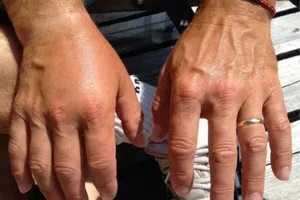 Tìm ra nguyên nhân khiến phụ nữ bị dị ứng nặng hơn nam giới