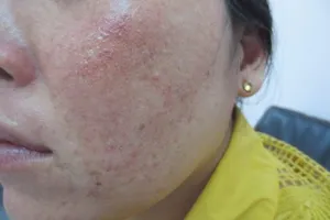 Môi biến dạng vì nhiễm cùng lúc ba loại giun