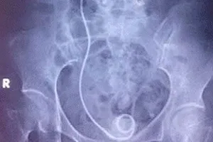 Bỏ quên 'vật lạ' trong cơ thể hàng chục bệnh nhân suốt 10 năm