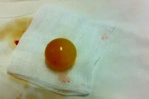 Trẻ tắc ruột do nuốt hạt đồ chơi