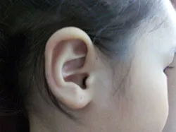 Lỗ nhỏ xíu như đầu kim ở vành tai trẻ là bệnh gì ?