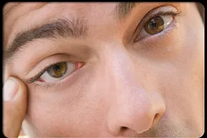 Bị nháy mắt liên tục là bệnh gì?