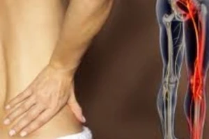 Ðau dây thần kinh liên sườn - Chớ coi thường