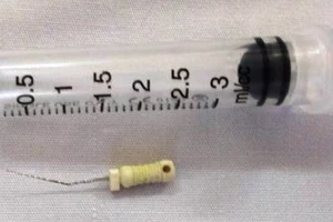 Bé 5 tuổi bị kim lấy tủy rơi vào đường thở khi đang chữa răng