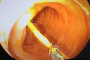 Thủng đại tràng do nuốt tăm tre