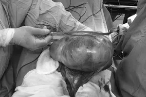 Mổ lấy khối u buồng trứng nặng 3,5kg cho bé 13 tuổi