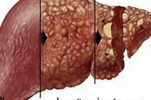 Có nên dùng thuốc bổ gan?