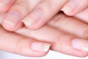 Móng tay bị mủn là bệnh gì?