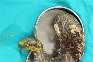 Lấy búi tóc 2 kg ra khỏi dạ dày bé gái